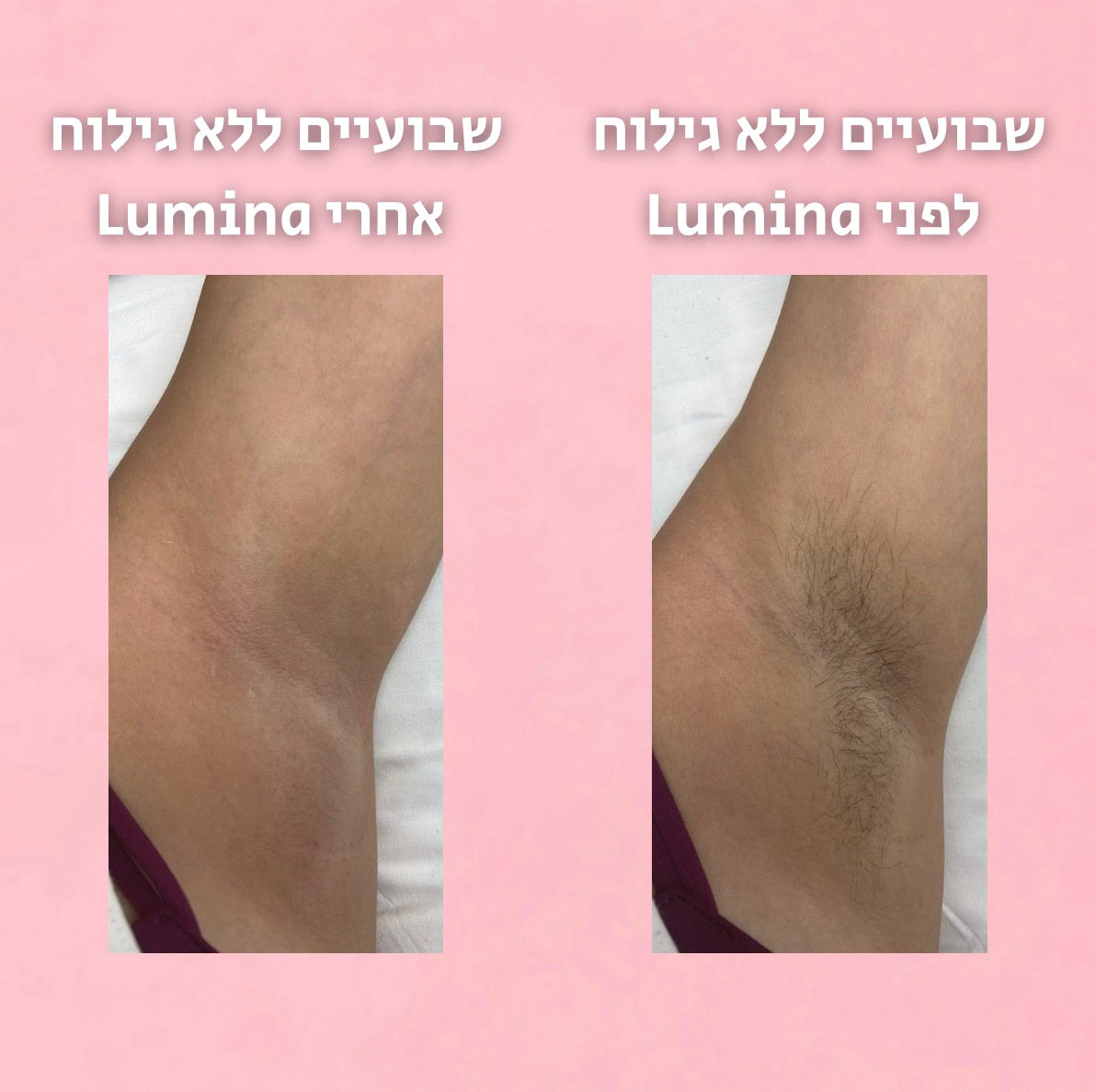 סרום לעיכוב צמיחת השיער